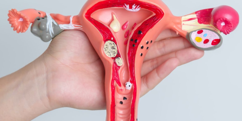 Endometriose